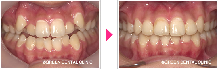 八重歯の治療前治療後