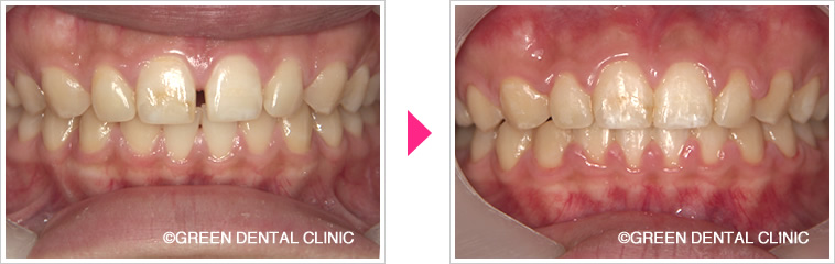 すきっ歯の治療前治療後