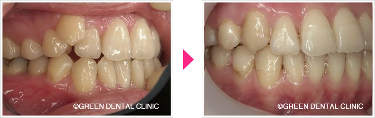 八重歯の治療前治療後