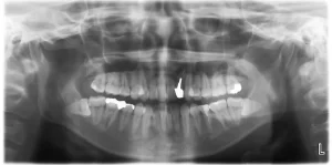 パノラマレントゲン写真　被ばくが心配な方へ　デジタルレントゲン